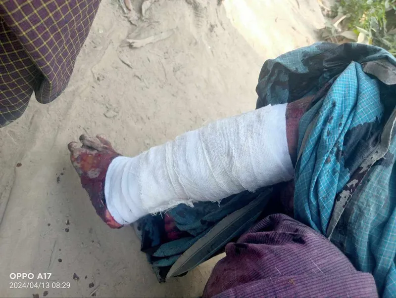 7 Rakhine children injured in remnant bomb explosion in Maungdaw